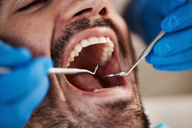 Best Emergency Wisdom Tooth Extraction in Soperton, GA