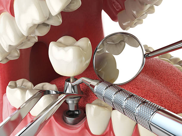 Best Lost Filling or Crown Replacement in Soperton, GA
